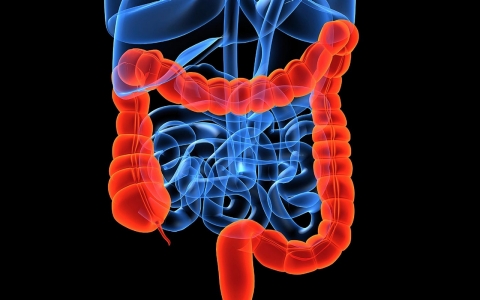 colon cancer