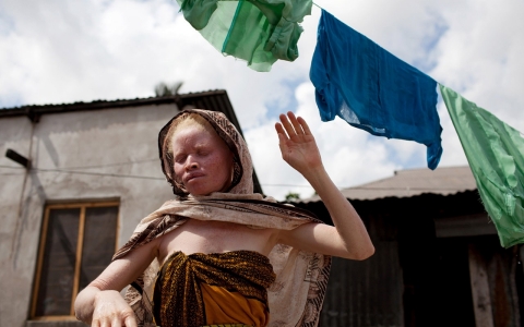 Thumbnail image for Abducted Tanzanian albino boy found dead with limbs severed