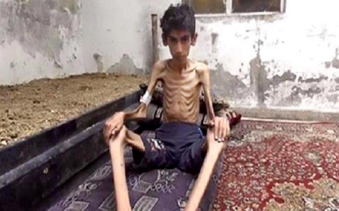 Thumbnail image for ‘Cowardly weapon’ of starvation claims lives of Syrians cut off from world